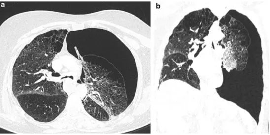 Fig. 1 a Axial and b coronal CT images through the thorax. Note the large left pneumothorax, mediastinal shift to the right, flattening of the left hemidiaphragm, emphysematous changes of the lung parenchyma, and the atelectatic area of the left upper lobe
