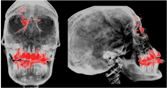 Fig. 3 Coronal maximum intensity projection. The metal fragments can be seen along the gunshot path