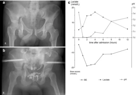 Table 3. Type of pelvic fractures according to the AO classification in 50 patients with pelvic ring disruption.