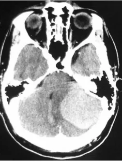 Fig. 2. Patient 1: T2-axial sequence with a predominantly cystic right hemispheric cerebellar lesion (haemangioblastoma) with minimal mass effect on the midline structures