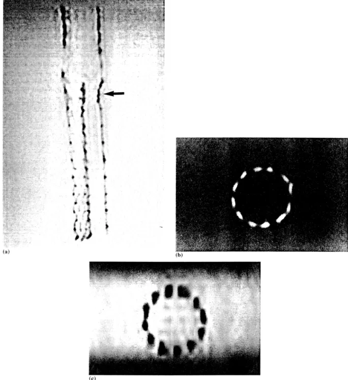 Fig.  2.  Coronal  3D  M R A   source  image  (a)  of  the  stent  graft.  The  woven  wires  of  the  stent-graft  are  well  visualized  on  the  image  against  the  contrast  enhanced  agar-gel