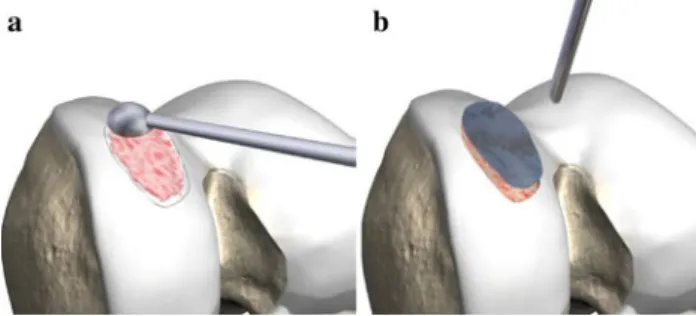 Fig. 2 Microfracturing should be performed with a 1.1 mm K-wire which is the author’s preferred method of treatment