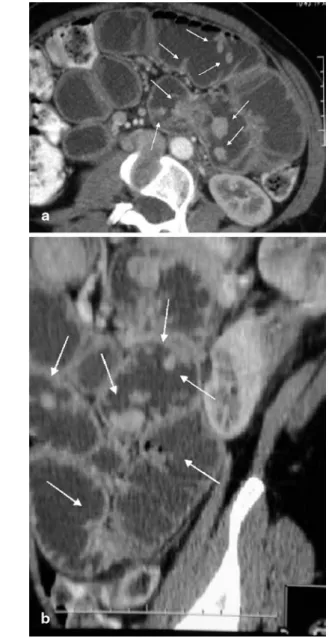 Fig. 3 a,b MDCTE in a 65-year-old man with known renal cell carcinoma, now developing hypervascular metastasis within the proximal jejunum (arrow): optimal luminal distension with neutral contrast medium and thin-slice acquisition allows for clear  visual-