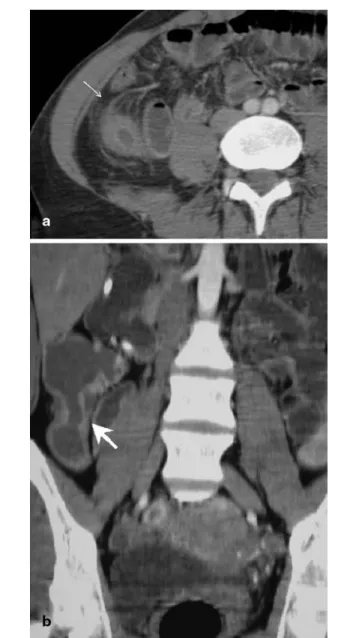 Fig. 5 a,b MDCTE in a 30-year-old woman with intermittent Crohn’s disease after ileocaecal resection in the past: signs of acute inflammation, that is, hyperemia of mesenteric vessels and extension of adjacent mesenteric edematous infiltration (thin  ar-ro