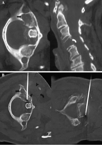 Fig. 1. A. Axial computed tomography showing an osteolyic lesion of the right lateral atlas mass (arrow) and another osteolysis in a sagittal reconstruction of C4 (curved arrow)