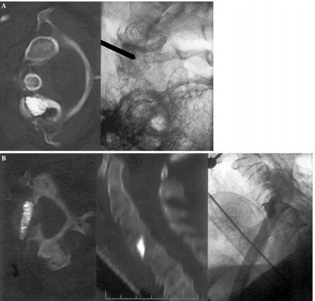 Fig. 2. A. Fluoroscopy image during the filling process of the right C1 body lesion and axial computed tomography after vertebroplasty.