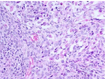Fig. 10 Malignant peripheral nerve sheath tumor. The proliferation is composed of intersecting fascicles of monomorphic spindle cells.