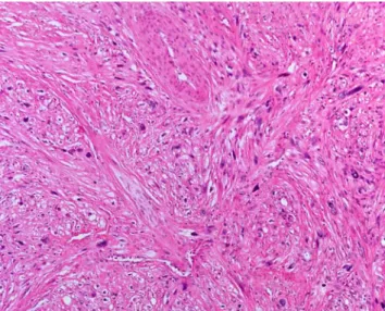 Fig. 1 Leiomyosarcoma. The tumor is moderately differentiated, composed of intersecting fascicles of spindle cells showing brightly eosinophilic cytoplasm and obvious nuclear atypia