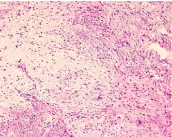 Fig. 6 Myxofibrosarcoma. This intermediate-grade myxofibrosar- myxofibrosar-coma is composed of an admixture of myxoid and cellular areas.
