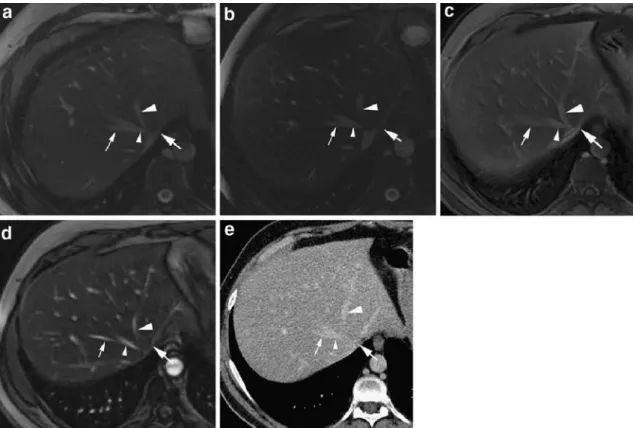 Fig. 1 a Transverse nonenhanced balanced steady-state free precession (bSSFP) image of the liver in a 35-year-old man at the level of the middle (MHV; small arrowhead) and left (LHV; large arrowhead) hepatic veins demonstrates accessory hepatic vein from s
