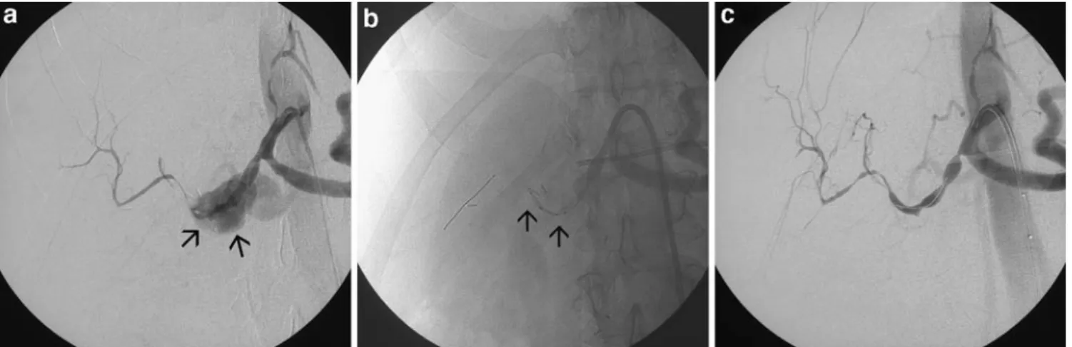 Fig. 2 A 61-year-old patient with suspected abdominal bleeding 28 days after pylorus-preserving Whipple pancreatic head resection.