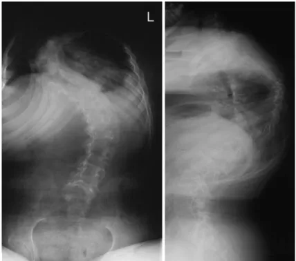 Fig. 1 Pre-operative ap and lateral radiographs of Patient 1.