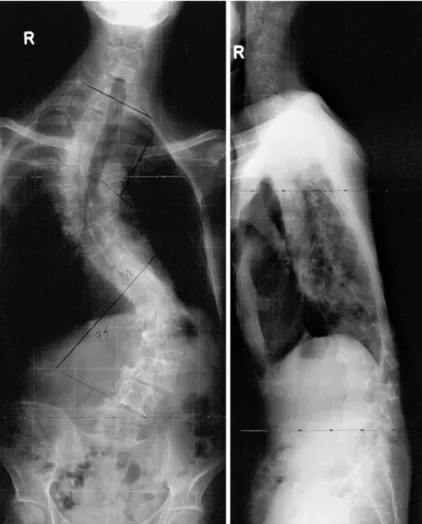 Fig. 4 Pre-operative ap and lateral radiographs of Patient 2 showing severe thoraco-lumbar scoliosis