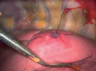 Figure 2. Intraoperative photograph of SPN previously marked by CT-guided deployment of the hook-wire device
