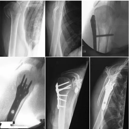 Fig. 1 Surgical technique of indirect fracture reduction using the plate as a buttress
