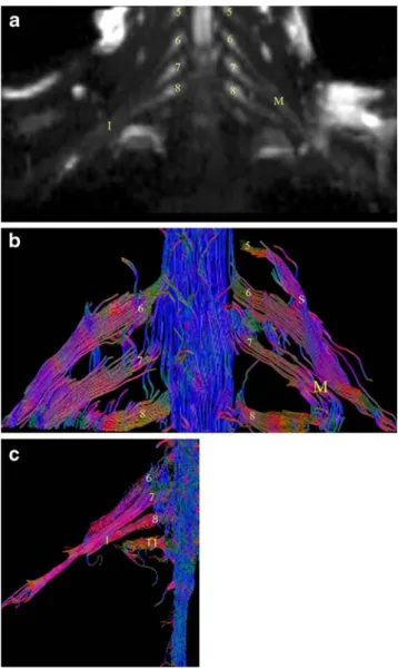 Fig. 1 a Normal neurography (b=1,000) and b tractography of the brachial plexus in a 37-year-old male volunteer