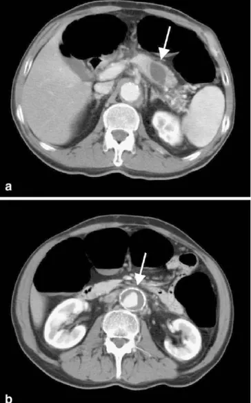 Fig. 3 IV contrast-enhanced CT colonography of a 59-year-old male patient with a surgically treated esophageal carcinoma