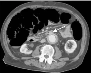 Fig. 6 Complex cystic mass with thickened septations of the left kidney ( arrow ) in a 76-year-old male patient (IV contrast-enhanced CT scan)