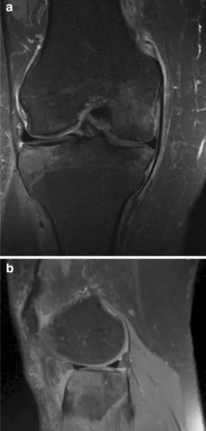 Fig. 2 Left knee: diffuse area of increased signal intensity in the lateral femoral condyle: a coronal, b sagittal