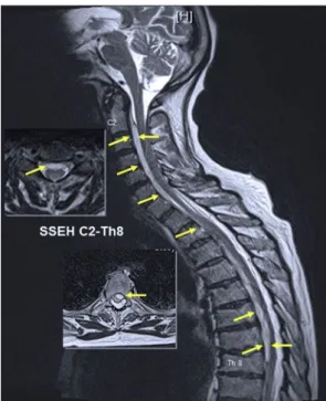 Fig. 2 MRI after 48 h revealed no epidural hematoma and no compression of the spinal cord