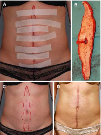 Fig. 2 Patient presenting after median laparotomy for contour optimization and scar revision