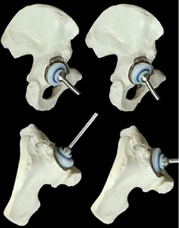 Fig. 1 The orientation of the acetabular reinforcement ring with hook (ARRH) (Zimmer, Warsaw, Ind.) is less critical than the contact with bone because the cement-polyethylene (PE) interface allows a moderate amount of freedom to further improve the positi