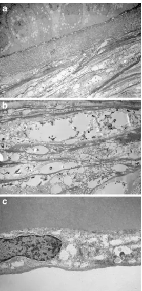 Fig. 2 a Electron microscopy of the cornea demonstrates vacuoles in epithelium, Bowman ’ s layer and stroma