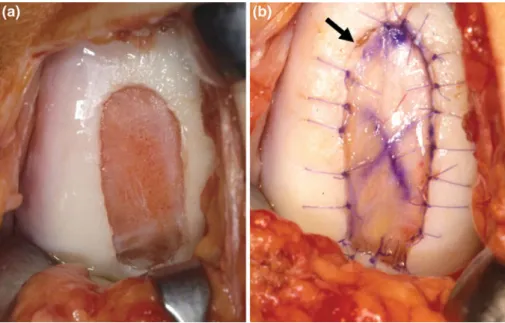 Fig. 1 Periosteum ACI: the  cartilage defect was debrided  back to healthy cartilage (left)