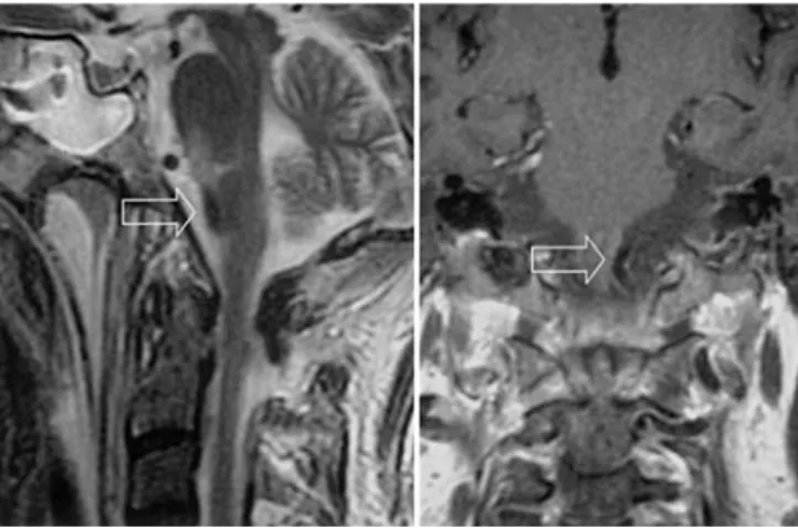 Fig. 1 Sagittal and frontal T2-weighted MRI sequences. Lesion in the pontomedullary junction (arrows)