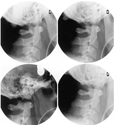 Fig. 6 a An MRI scan of AOD shows an epidural  haem-atoma (arrows) with b  associ-ated lesion of the left vertebral artery (arrow)