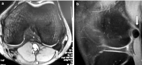 Fig. 2 a MRI scan of the left knee. The cyamella is shown with cortical and cancellous parts in the popliteal tendon  posterior-superior