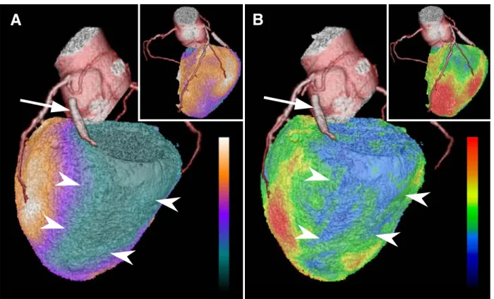 Figure 1. A, Three-dimensional (3D) volume-rendered (VR) fusion image generated from computed tomography (CT) angiography and myocardial perfusion SPECT with 99m Technetium-tetrofosmin at rest