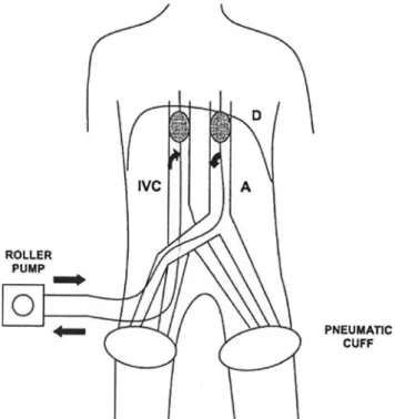 Fig. 1 Abdominal stop-Xow perfusion (from Pilati et al. [5]).  IVC, inferior vena cava; A, aorta; D, diaphragm