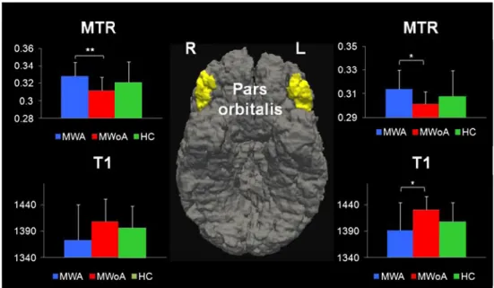 Fig. 2 Region of interest evaluation of MTR and T1 contrasts in the pars orbitalis of the prefrontal cortex in MWA, MWoA, and HC (* p &lt;0.05,