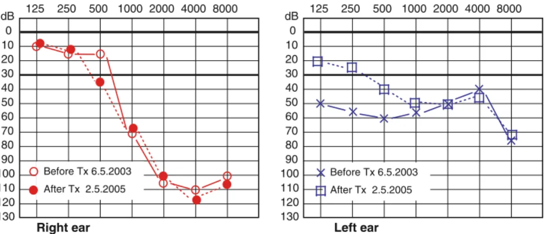 Fig. 1 Course of hearing function in pure tone audiogram of case 1