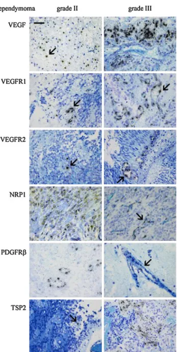 Fig. 2 Cell distribution determined by in situ hybridization of the mRNAs for neurogenic/angiogenic factors in grade II ependymoma and grade III ependymoma