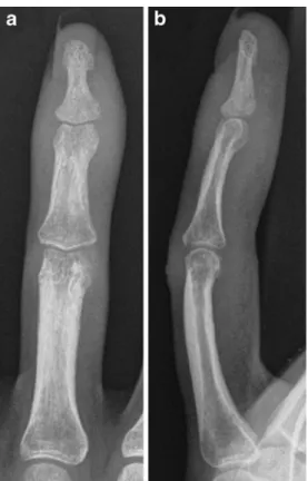 Fig. 1 Posteroanterior (a) and lateral (b) radiographs of the left long finger