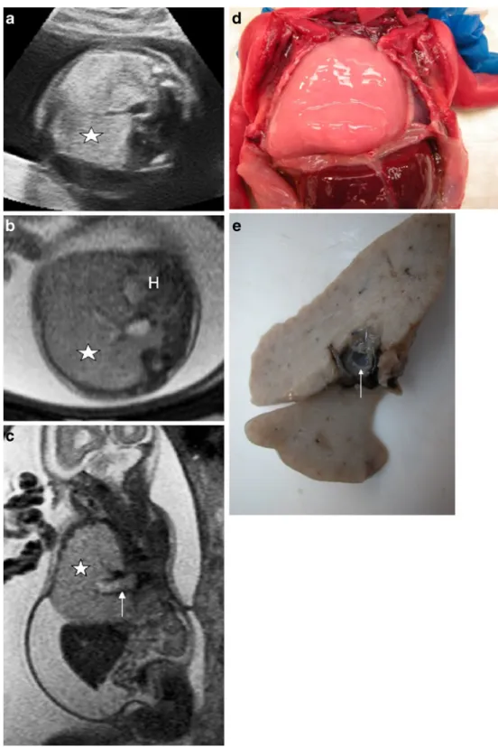 Fig. 6 Bronchial atresia.