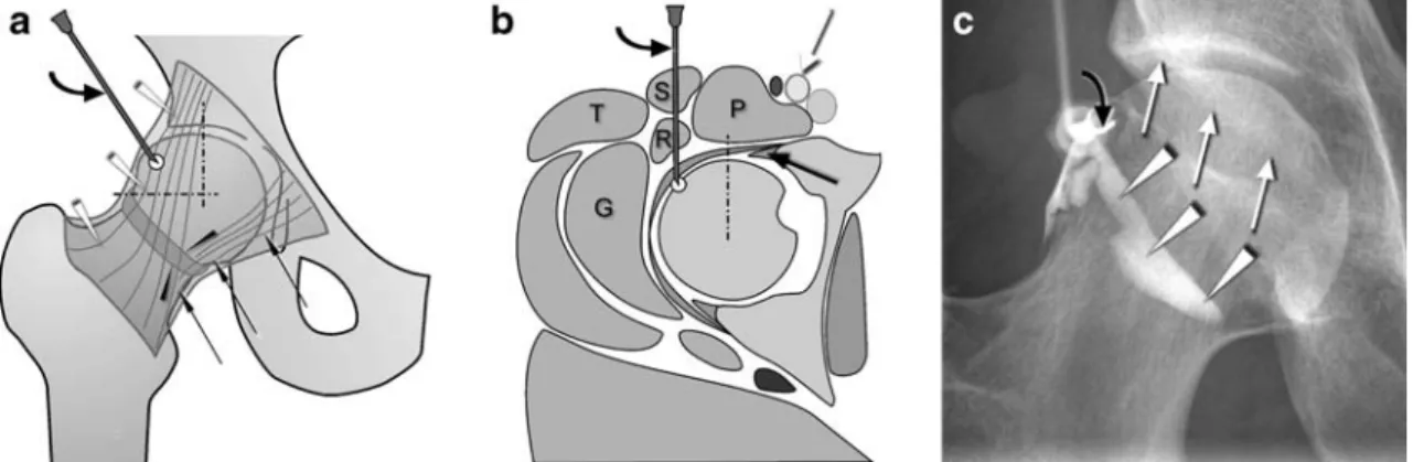 Fig. 1 Femoral head injection technique. a Schematic drawing of the target site at the lateral aspect of the supero-lateral quadrant of the femoral head