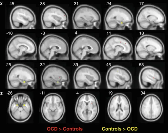 Fig. 2 Results of the preliminary ALE meta-analysis. The red foci represent areas where paediatric OCD patients exhibit overactivation in comparison to healthy controls while the yellow foci index hypoactivation in paediatric OCD patients