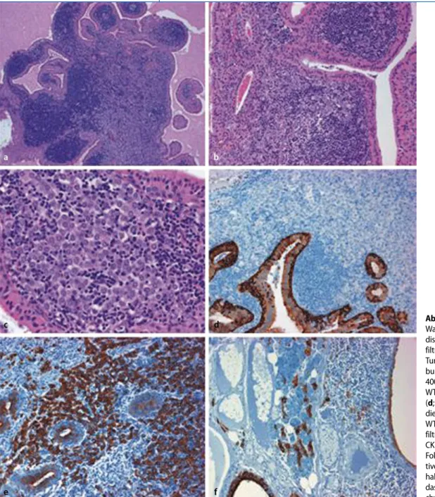 Abb. 1  9  Multizystischer  Warthin-Tumor (WT) mit  disseminierten  Karzinomin-filtraten im lymphozytären  Tumorstroma (a–c,  HE-Fär-bung, Vergr