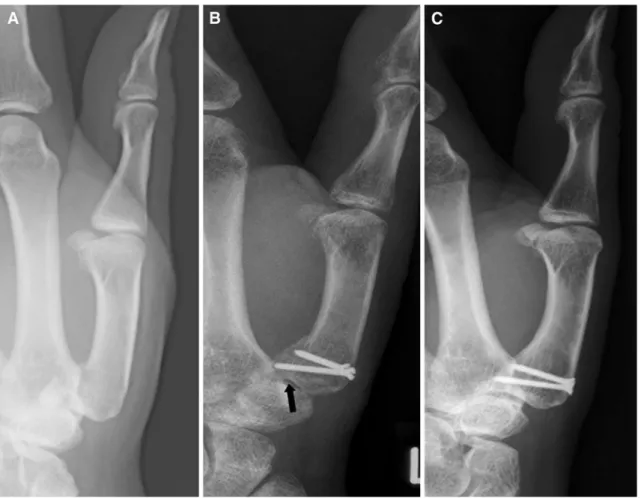Fig. 1 Examples of a Gedda Type II fracture: pre-operative (a), 4 months (b) and 71 months (c) after operation