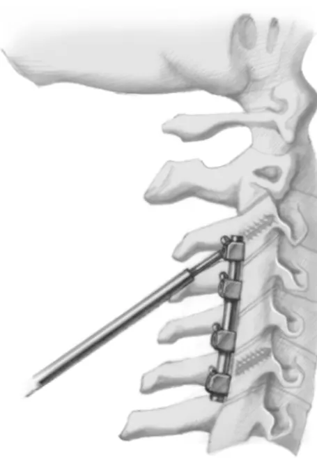 Figure 21. Finally, the intermediate connectors are brought into the desired position, the holes  are drilled through the connectors, the length of the screws is determined, the holes are tapped,  and the screws inserted