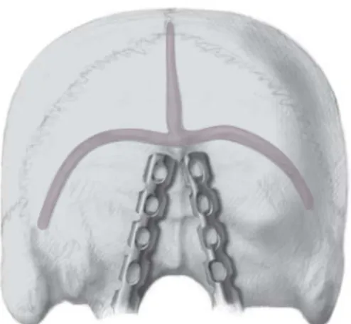 Figure 4. Screw insertion into the occiput. The thickness of the skull varies considerably