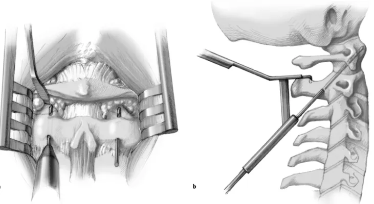 Figure 6. Anchorage of screws in C2. On account of the particular anatomic conditions at C2, screw placement at this level is different from that at  C3–C7