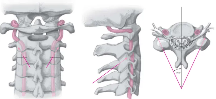Figure 7. Anchorage of screws in C3–C7. The screws’ entry points lie 1–2 mm cranial and medial to the midpoint of the lateral masses