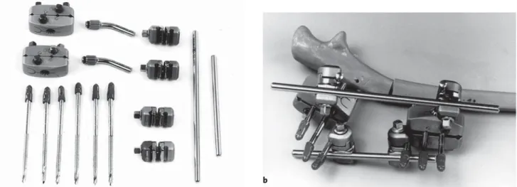 Figure 3. Installation of fixator: under image intensification stab inci- inci-sion and insertion of the first Apexpin perpendicular to the  longitudi-nal axis of the ulnar shaft and close to the posterior border in direction  of the anterior surface of th