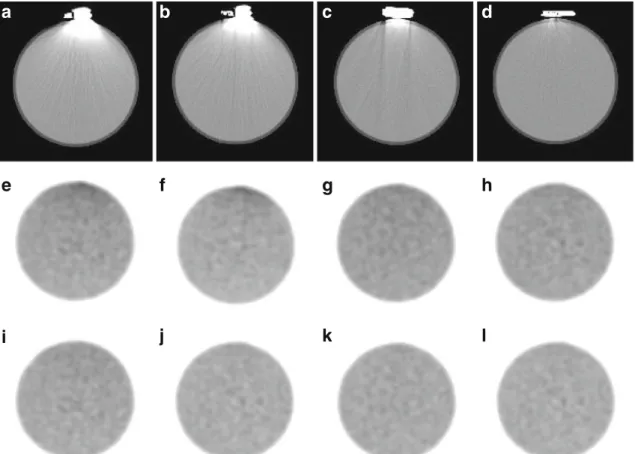 Table 1. Overestimation (in%) of attenuation coefficients for μ -maps and tracer uptake values derived from PET images of the Ge-68 phantom for the various pacing devices obtained with and without MAR in CT images (P G 0.0001 in all cases)