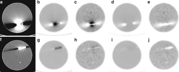 Figure 2 shows representative slices of CT and PET images of the Ge-68 phantom where the presence of cardiac pacing devices resulted in metallic artifacts on CT images and consequently, through CT-AC, on apparent tracer  accumu-lation in the proximity of t