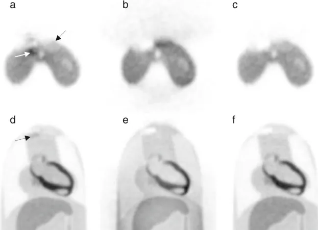Fig. 5. a–c Transverse and d–f coronal views of a representative PET slice of the RSD heart/thorax phantom in the presence of pacemaker 1